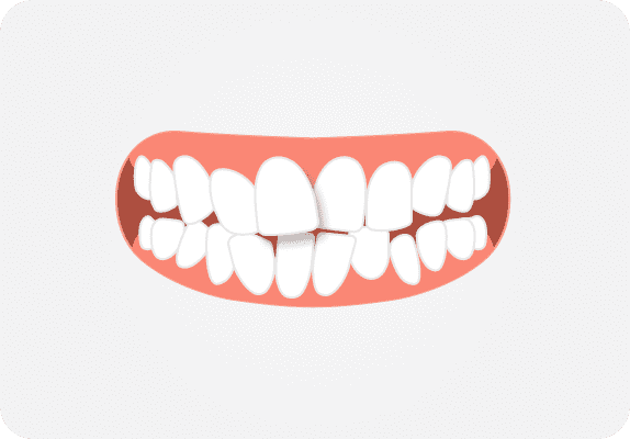 Аномалии положения зубов