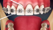 Использование зубной нити при ношении брекетов