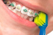  Специальные зубные щетки для брекет-систем