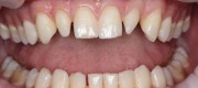 Конические и шиловидные зубы