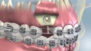 Ортодонтическое вытяжение зуба