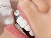 Установка виниров в стоматологии
