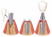 Двухэтапная имплантация в стоматологии