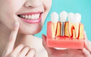 Приживление зубных имплантов в стоматологии