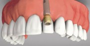 Нюансы дентальной имплантации передних зубов