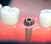 Почему могут выпадать импланты зубов