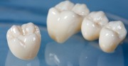 Реставрация зубов керамокомпозитными коронками