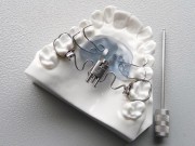 Дистализация моляров в стоматологии