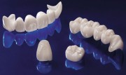 Безметалловые коронки в стоматологии