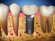 Импланты Denti System