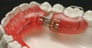 Обзор ортодонтических аппаратов механического действия