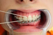 Удаление зубов при установке брекетов
