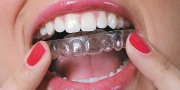 Выравнивание зубов капой - виды, лечение