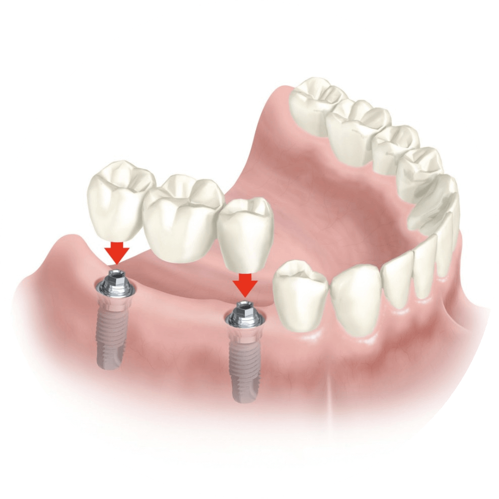 Вставить удаленный зуб. Мостовидный протез на 2 зуба жевательных. Мостовидный имплант на 4 зуба. Несъёмный мостовидный протез челюсти. Импланты мостами нижняя челюсть.