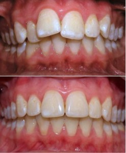 Ортодонтическое лечение зубов спб