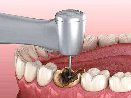 Причины гниения зубов
