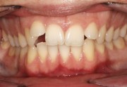 Зубоальвеолярное укорочение в ортодонтии