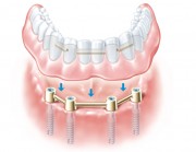 Съемный протез на имплантах в стоматологии