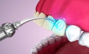 Ультразвуковое отбеливание зубов