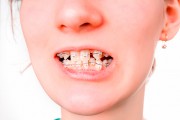 Нужно ли удалять зубы при установке брекетов?