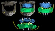 3D навигация при имплантации зубов