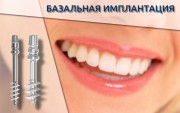 Особенности базальной имплантации зубов