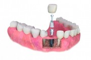 Одномоментная имплантация зубов в стоматологии