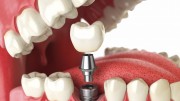 Недорогое восстановление зубов имплантацией
