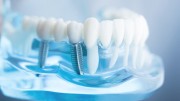 Методы имплантации зубов