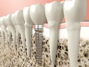Приживление зубных имплантов