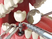 Что делает врач стоматолог-имплантолог?