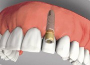 Эндоскопическая имплантация зубов