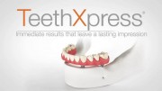 Имплантация Teethxpress
