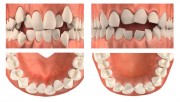 Скученность зубов и методы лечения