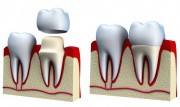 Восстановление искусственной коронки зуба