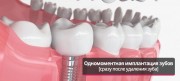 Способы протезирования после удаления зубов