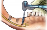 Повреждение нижнечелюстного нерва при имплантации зуба