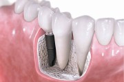 Вопросы имплантации зубов при гепатите