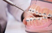 Способы фиксации брекетов в стоматологии