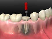 Депульпация зубов перед протезированием