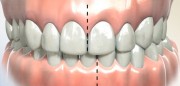 Смещение средней линии зубов