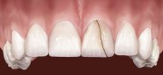 Трещины на переднем или боковом зубе