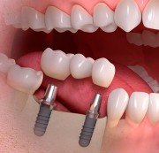 Сложное протезирование зубов