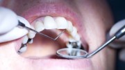 Трепанация зуба