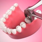 Удаление подвижного зуба в стоматологии