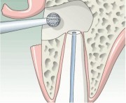 Удаление кисты зуба цистотомией