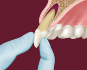 Реплантация в стоматологии
