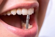 Причины удаления зубного импланта