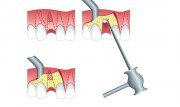 Резекция зубного корня