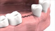 Расхождение швов после имплантации зубов